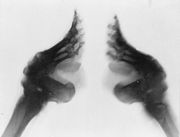 Bound feet (X-ray).jpg